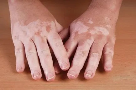 5 hazai jogorvoslati amelyek segítenek a vitiligo