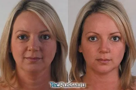 3D mezoniti за стягане на кожата на лицето и тялото (tredlifting) - процедура, снимки, отзиви и тарифи