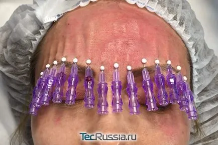 3D mezoniti за стягане на кожата на лицето и тялото (tredlifting) - процедура, снимки, отзиви и тарифи