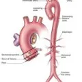 Abcesele (ulcer) (abscessus) etiologia, patogeneza, diagnosticul diferențial, rezultatul tratamentului,