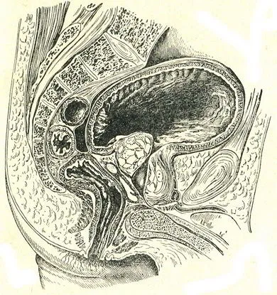 Prosztata adenoma, urológia