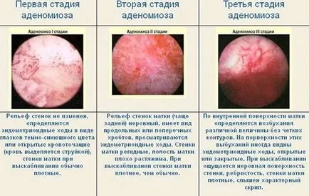 Adenomioza, endometrioza, și care este diferența