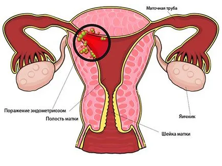 Adenomioza, endometrioza, și care este diferența