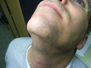 Алопеция на брадата при мъжете води и процедури - 