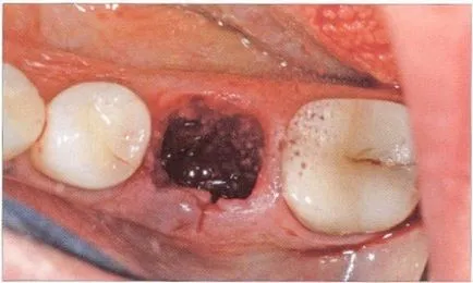 Alveolitis foghúzás után és tüneteinek kezelésére egy fotó és videó