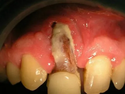 Alveolitis foghúzás után és tüneteinek kezelésére egy fotó és videó