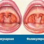 Възпалено гърло без антибиотици могат да бъдат излекувани