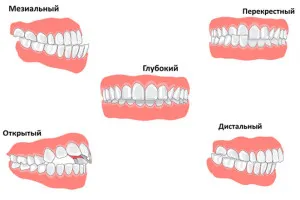 Аномалии на развитие и деформация на челюстите причините за