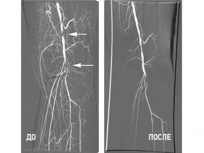 Angioplasztika és stent beültetés végtagok