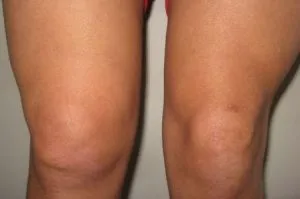 Симптоми и лечение на колянната става chondromatosis