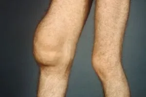 Simptomele si tratamentul genunchiului chondromatosis comun