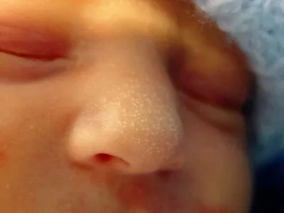 A kiütés az arcon újszülött 1 hónap okai és kezelése
