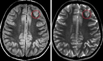 Lobnodolevaya epilepsie simptomatică