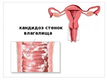 Симптомите на гъбична инфекция при жените как точно да се определят знаците на млечница