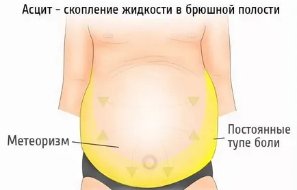 ascita abdominală că este în oncologie, lichidă și provoacă la femei, acumularea în abdomen