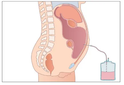 ascita abdominală că este în oncologie, lichidă și provoacă la femei, acumularea în abdomen