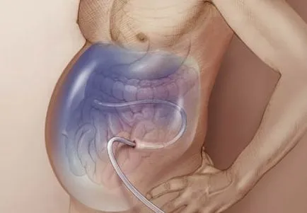 ascita abdominală că este în oncologie, lichidă și provoacă la femei, acumularea în abdomen