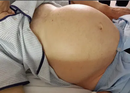 ascita abdominală că este în oncologie, lichidă și provoacă la femei, acumularea în abdomen