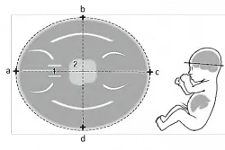 Dimensiune biparietal cap fetale