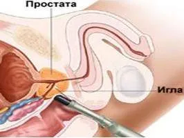 A biopszia a prosztata Moszkvában, a tőke hálózatának klinikák