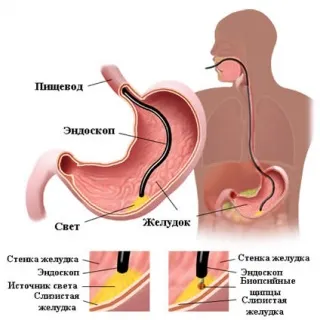 Биопсия на стомаха и ендоскопска полипектомия в Москва мнения и цени за биопсия на стомаха полипи