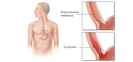 Жлъчните кипене гастрит симптоми, лечение