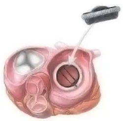 Blocada a valvei inimii - tratamentul inimii