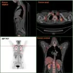 Brown grăsime - o nouă perspectivă cu privire la tratamentul obezității