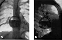 Bronhogenix chist - cauze, simptome, diagnostic și tratament