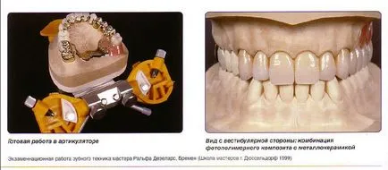 Mi a kapocs fogsor protézisek és típusú kapocs - Ohi-s