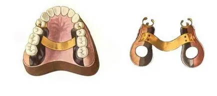 Mi a kapocs fogsor protézisek és típusú kapocs - Ohi-s
