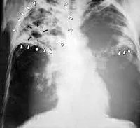 tuberculoză pulmonară Ciroză - cauze, simptome, diagnostic și tratament