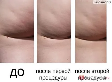 Salon kezelés lipo-készletek extrém (lipostok) Germaine de Capuccini - «a történet a szalon