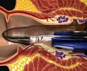 Hemoroizii Dezarterizatsiya (hal-RCR) comentarii, progresul operațiunii, efectele