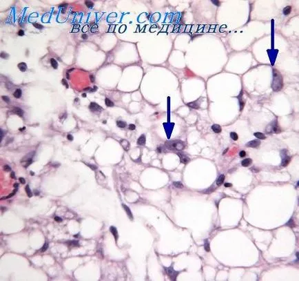 diagnózis liposarcoma