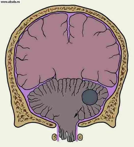 Zavar, zavar az agy Medical Encyclopedia