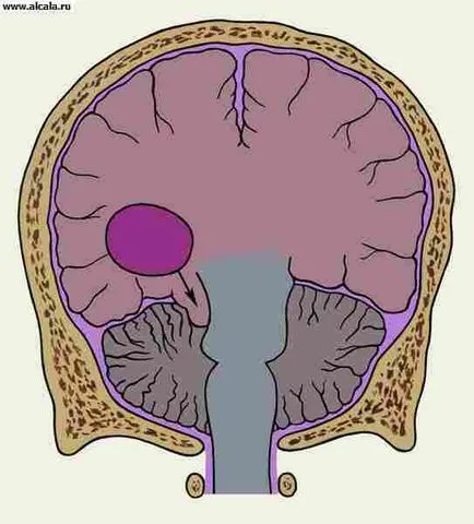 Zavar, zavar az agy Medical Encyclopedia