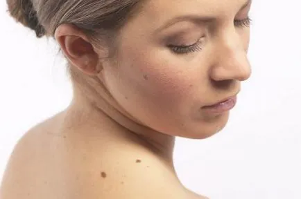 Dyubreya melasma szaporodó áttétek anyajegyet, kezelések