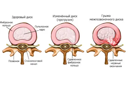 Екструдиране на гръбначния дискове, че е