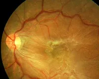 membrane epiretinal - cauze, simptome, diagnostic și tratament