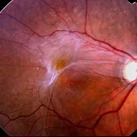 Epiretinális membrán a szem okoz, és olyan betegségek kezelésére,