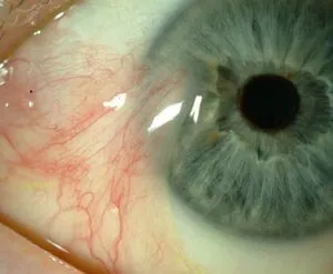 Epiretinális membrán a szem okoz, és olyan betegségek kezelésére,