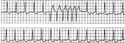 glicozide cardiace intoxicație electrocardiografice