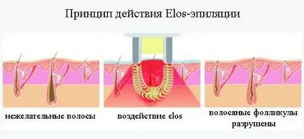 Elos depilatoare (Elos), ce este, contraindicații și efecte, prețuri, fotografii înainte și după