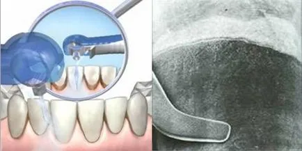 Елитът в Октомври - Лечение на пародонтит - система от 