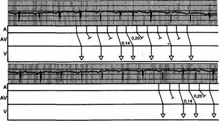 glicozide cardiace intoxicație electrocardiografice