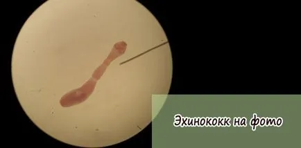 Echinococcosis hólyagféreg fotó külleme