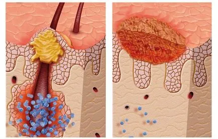 Folliculitis глава от опасна инфекция стафилокок