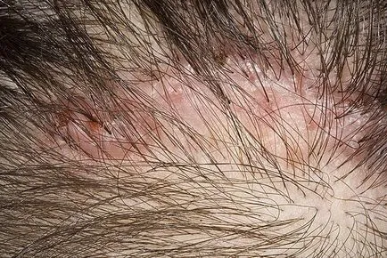 Folliculitis глава от опасна инфекция стафилокок