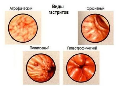 Gastrită, ulcer gastric, dureri de stomac